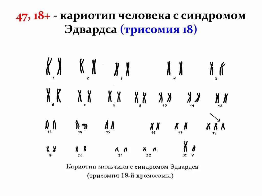 Кариотип человека с синдромом Эдвардса. Кариограмма синдрома Эдвардса. Кариотип больного с синдромом Эдвардса. Трисомия синдром Эдвардса кариотип.