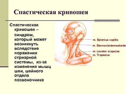 Спастическая кривошея