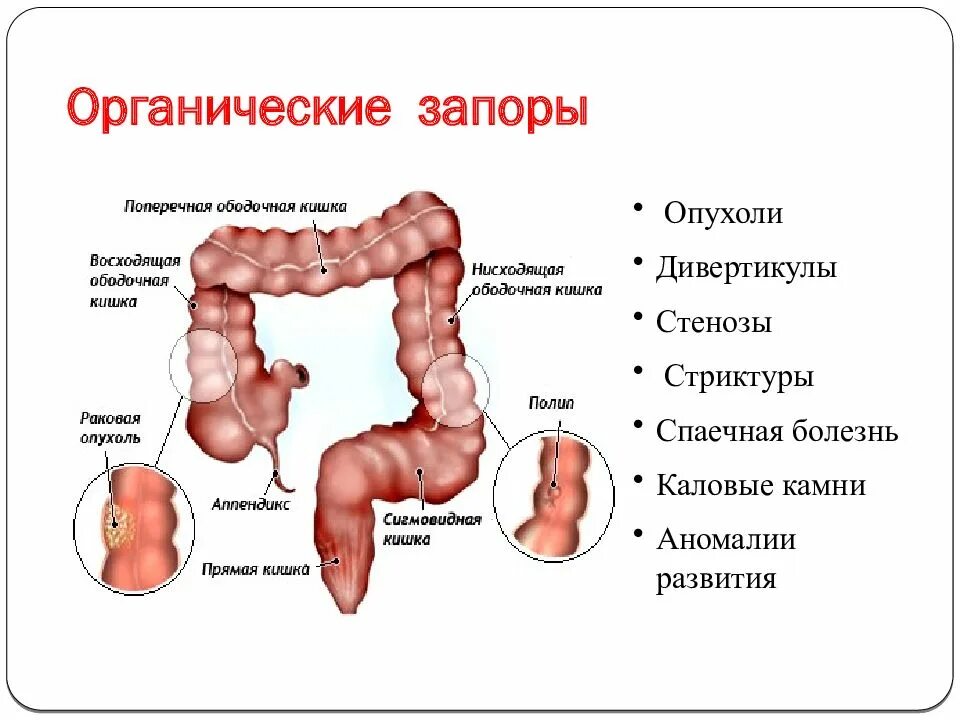 Отделы Толстого кишечника ободочная кишка. Поперечно-ободочная и сигмовидная кишка. Запор.