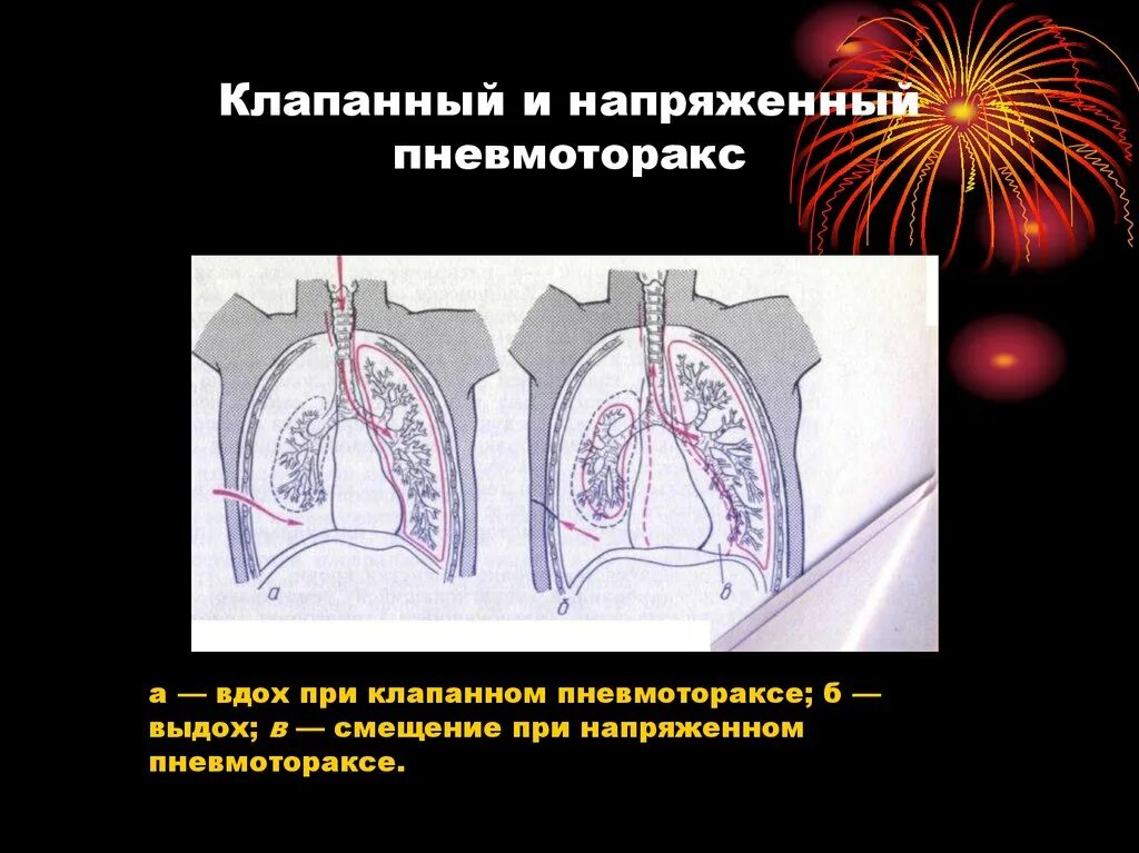 Напряженный пневмоторакс помощь