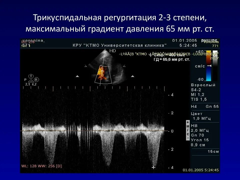 ЭХОКГ 1 степени. Недостаточность трикуспидального клапана ЭХОКГ. Эхокардиография митральная регургитация 1 степени. Степени регургитации митрального клапана по УЗИ.