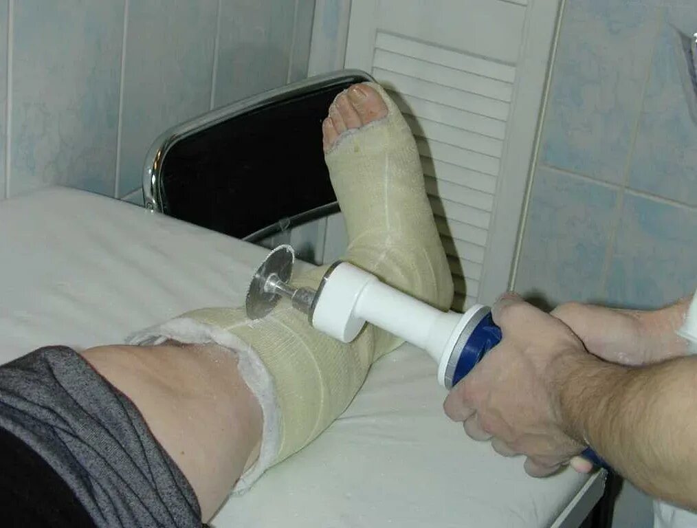 Можно наступать на гипс. Целлакаст гипс. пластиковый гипс на колено. гипс при переломе голени.