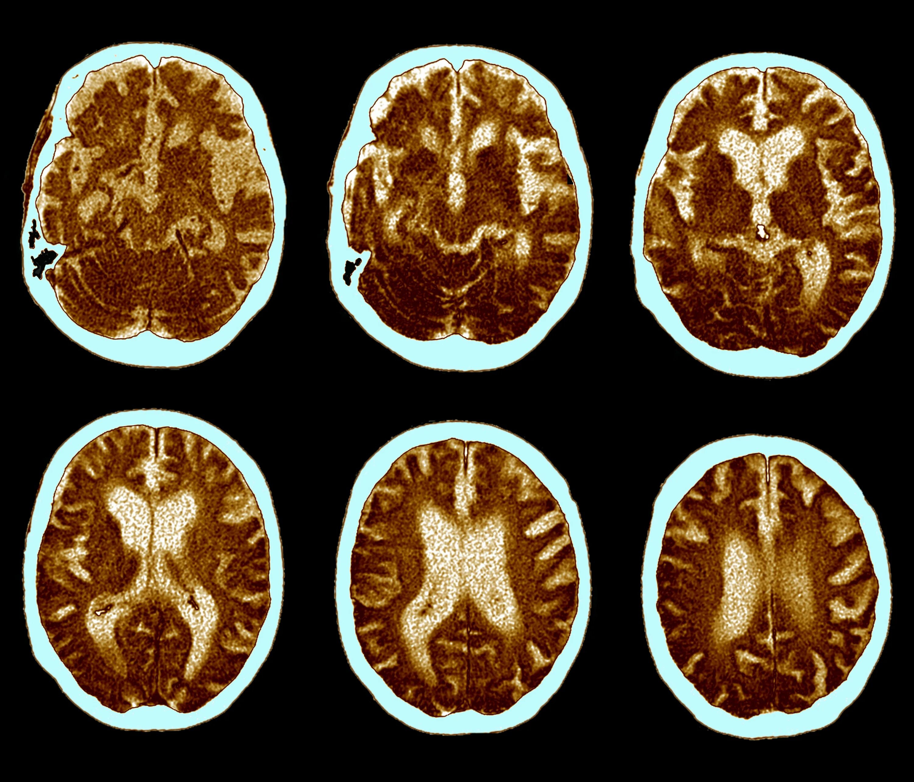 Болезни мозга степени. Мозг здорового человека и Альцгеймера. Болезнь Альцгеймера. Болезнь Альцгеймера мозг.