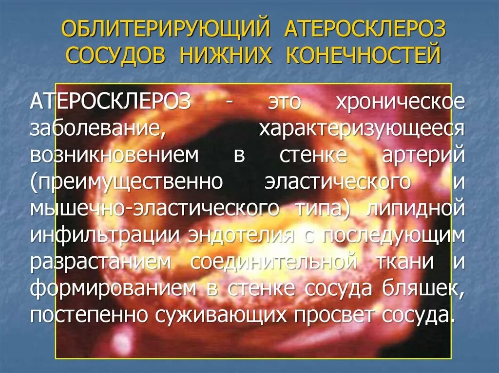 Код атеросклероз сосудов. Облитерируюший атеросклероз с. облитерирующий атеросклероз сосудов конечностей. облитерирующий атеросклероз нижних. облитерирующий атеросклероз сосудов нижних конечностей код.