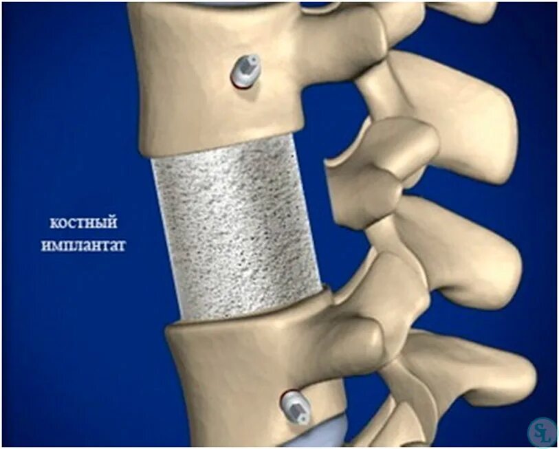 Имплант шейного отдела позвоночника. Титановый Кейдж в позвоночнике. Кейдж имплант поясничного отдела. Спондилодез поясничного отдела позвоночника Кейджем. Имплантация позвонка поясничного отдела.