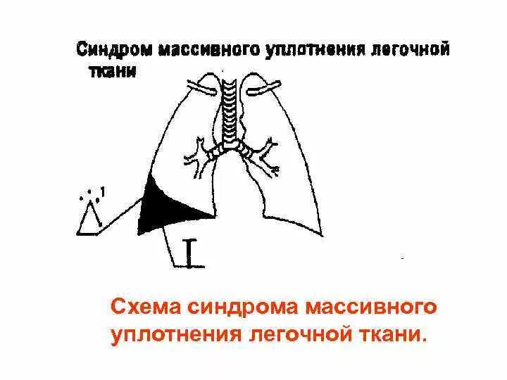 Типы уплотнения легочной ткани. Синдром нормальной легочной ткани. синдром массивного уплотнения легочной ткани. синдром повышенной воздушности легочной ткани схема. патогенез уплотнения легочной ткани.