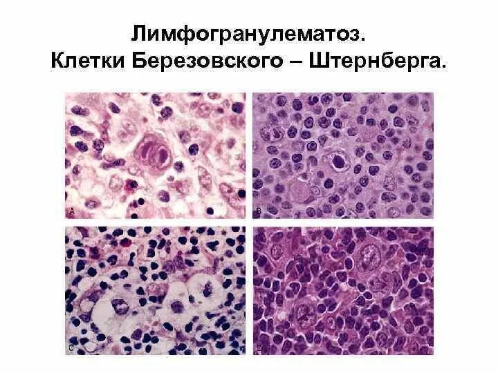 Клетки рида. Клетки Березовского-Штернберга гистология. Клетки Рида Березовского Штернберга. Лимфогранулематоз цитология. Лимфогранулематоз клетки Березовского Штернберга.