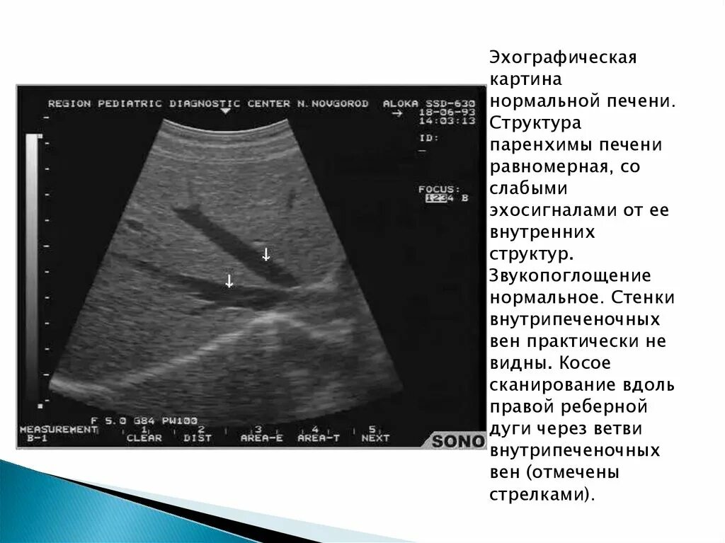 Гемангиома печени на УЗИ Диагностер. Книга ультразвуковая диагностика печени. Узи печени схема