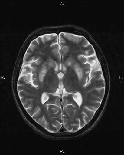Резидуальное поражение головного мозга. Метаболическая энцефалопатия мрт. Токсико-метаболическая энцефалопатия мрт. Резидуальная энцефалопатия мрт. Резидуальная энцефалопатия кт.