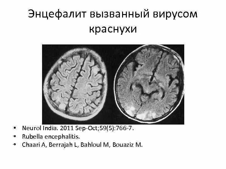 Краснушного энцефалита. Коревой энцефалит классификация. Энцефалит головного мозга у взрослых