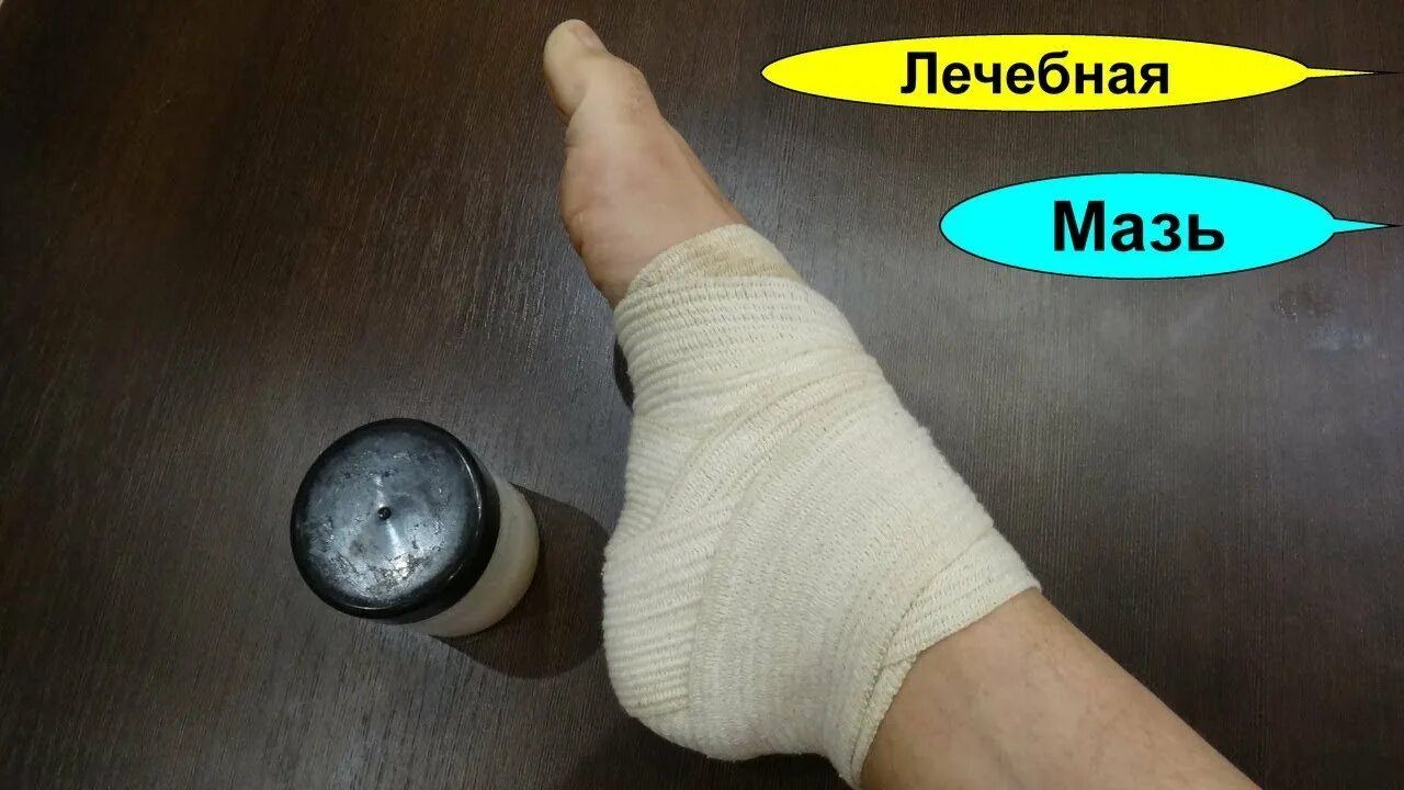 Компресс от пяточной шпоры. Компресс для шпору в пятке. компресс на пятку при пяточной шпоре. шпору на пятке солидол. лечение пяточной шпоры народными методами.