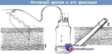 Удаление дренажа