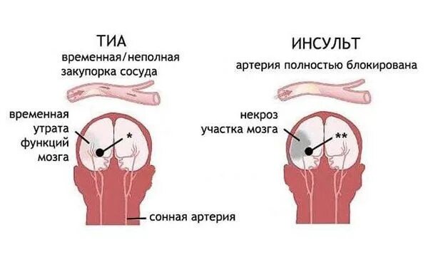 Отличие ишемии. Транзиторный ишемический инсульт симптом. Транзиторная ишемия атака симптомы. Тиа и ишемический инсульт. Транзиторная ишемическая атака головного мозга симптомы.