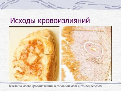 От чего происходит кровоизлияние