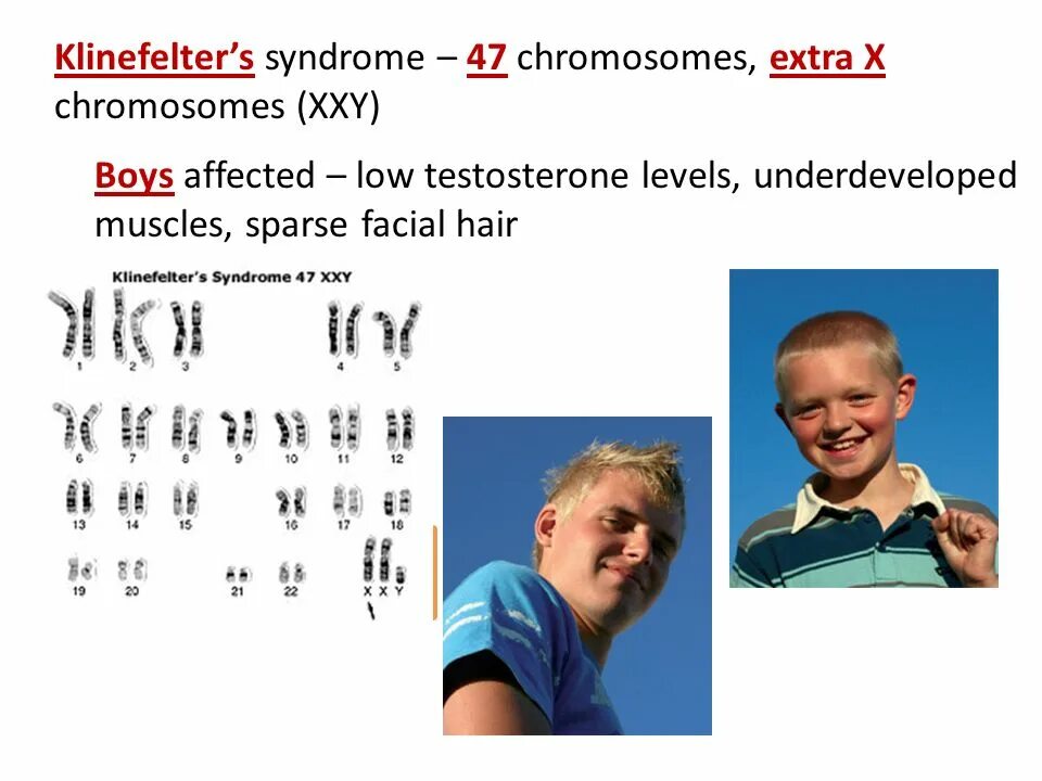 Xxy синдром Клайнфельтера. Синдром Клайнфельтера внешность. Синдром Клайнфельтера 47 xxy.