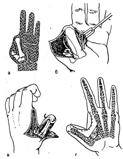 Операция на большом пальце руки. Ампутация фаланги кисти. Экзартикуляция пальцев кисти. Ампутация фаланги пальца кисти операция. Травматическая ампутация дистальной фаланги 1 пальца правой кисти.