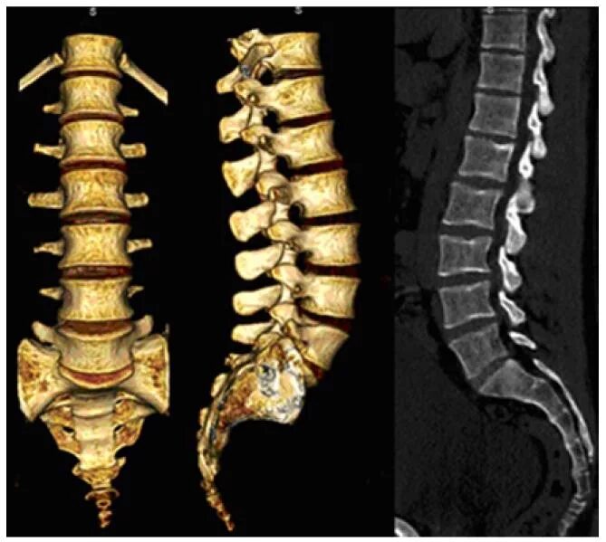 Кт пояснично-крестцового отдела позвоночника норма. СКТ грудного отдела позвоночника. МСКТ поясничного отдела позвоночника. Кт грудного и пояснично крестцового отдела позвоночника.