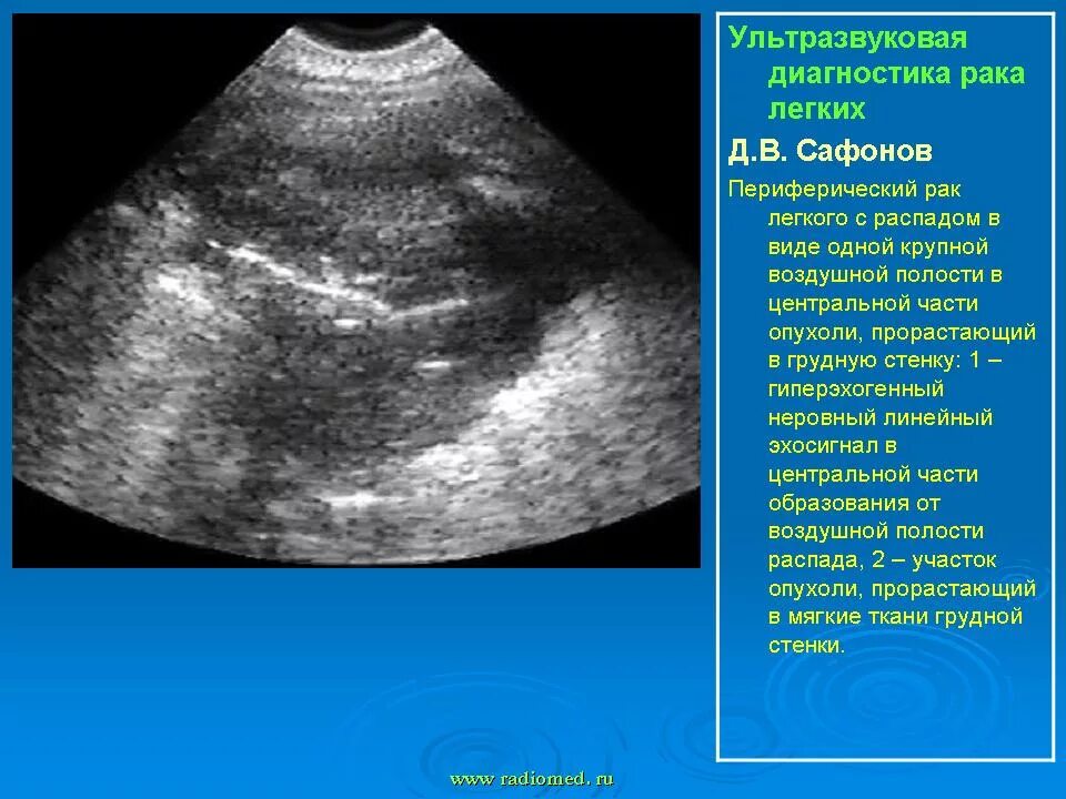 Пневмония на узи. Ультразвуковое исследование. Плевральные полости по узи норма мм. Ультразвуковое исследование плевральной полости. Узи легких детям.
