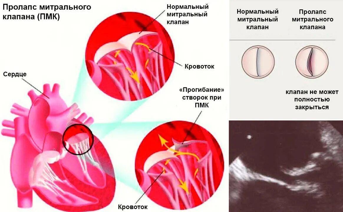 Что такое пролапс митрального клапана. Пролапс трикуспидального клапана 2 степени. Пролапс центрального клапана сердца 1 степени. Пролапс двустворчатого клапана. Прогиб митрального клапана 1 степени.