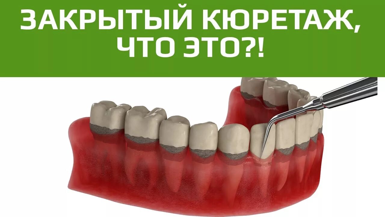 Кюретаж. Кюретаж пародонтальных карманов. кюретаж закрытый в стоматологии.