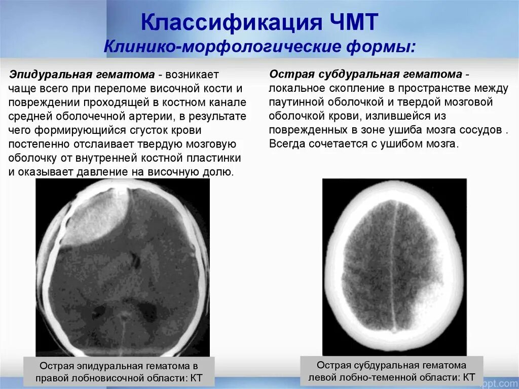 Гематома черепно мозговой травме. Субдуральная гематома рентген. Субдуральная и эпидуральная гематома. Эпидуральная гематома лобной области кт. Пластинчатая субдуральная гематома.