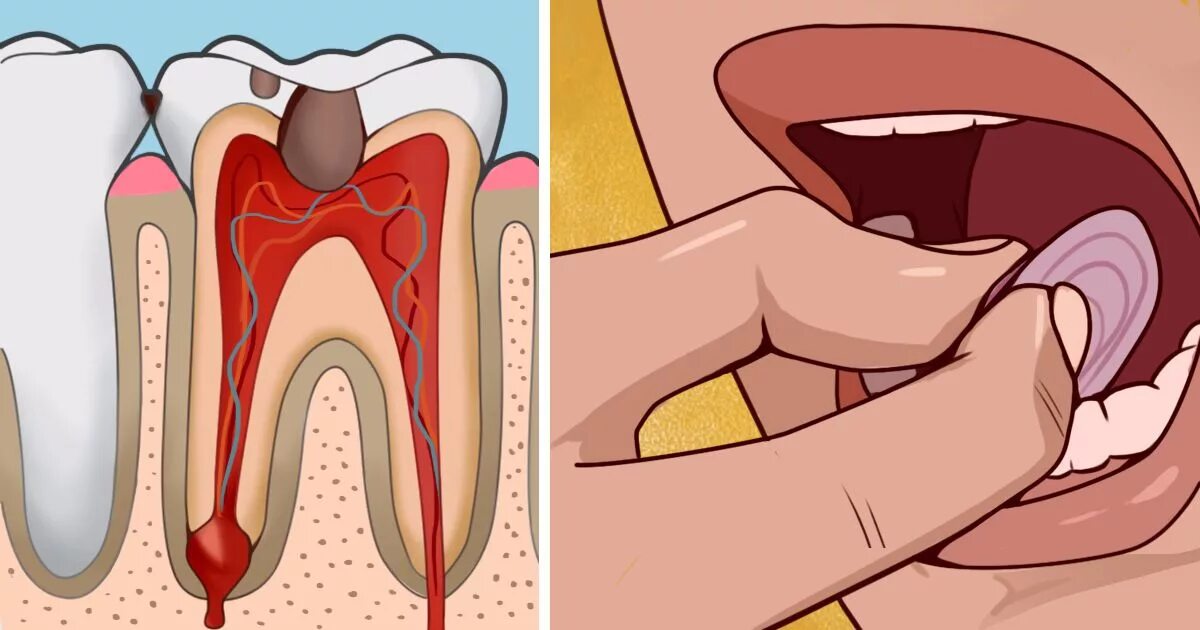 Сильно болит зуб что делать в домашних