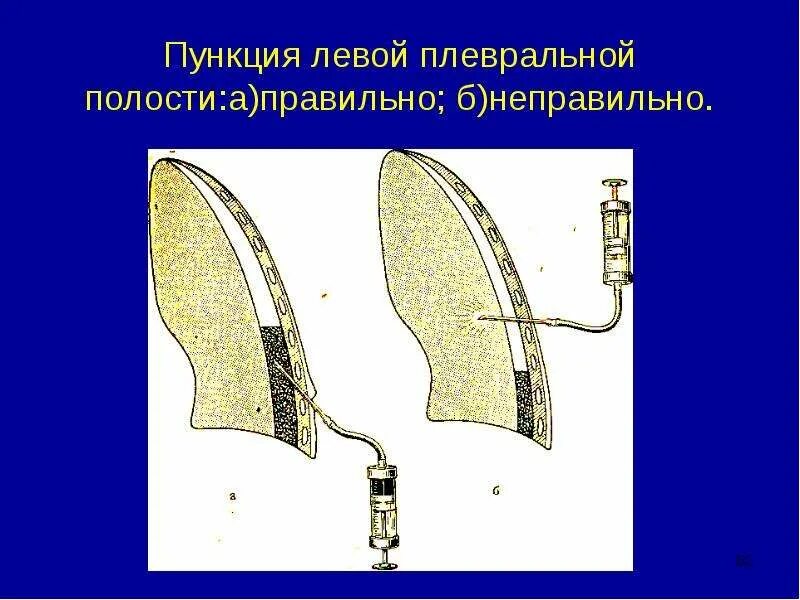 Плевральная пункция торакоцентез. Диагностическая пункция плевральной полости. Пункция плевральной полости техника. Плевральная полость.