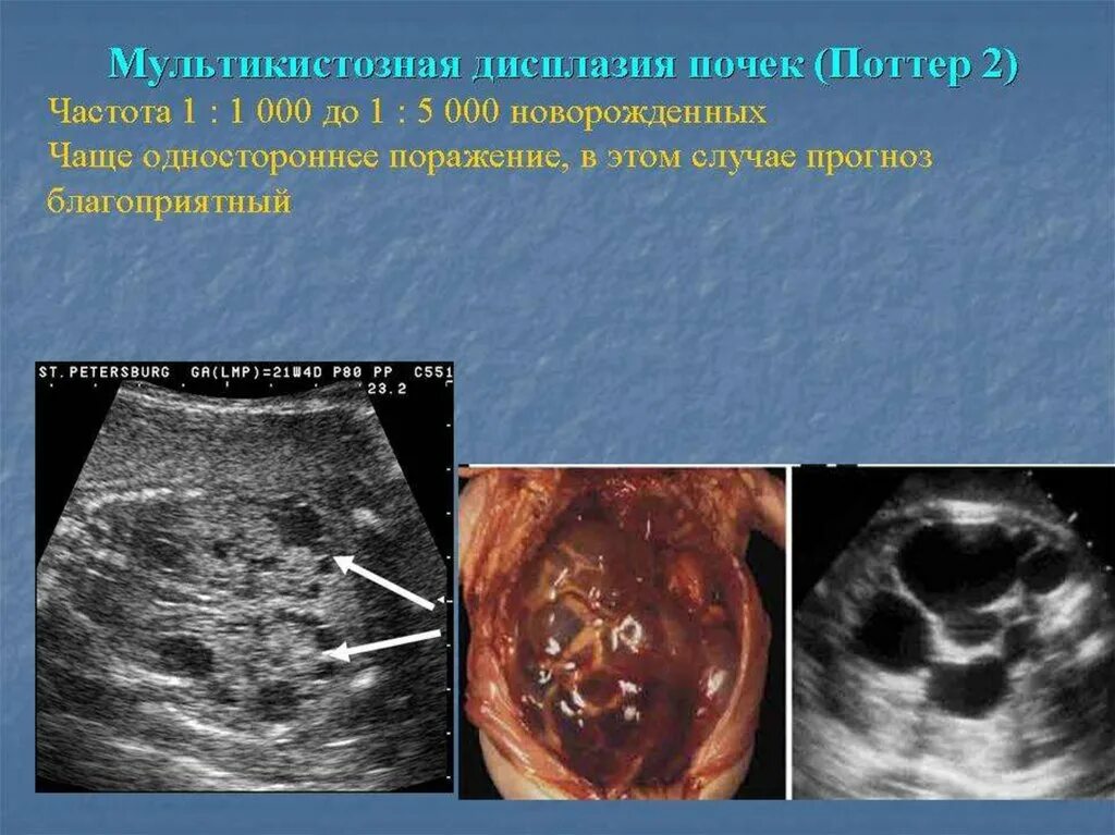 Дисплазия или мультикистоз. Гипопластическая дисплазия почек. Мультикистозная дисплазия почки на узи. Мультикистозная дисплазия почки на узи. Дисплазия почек это.