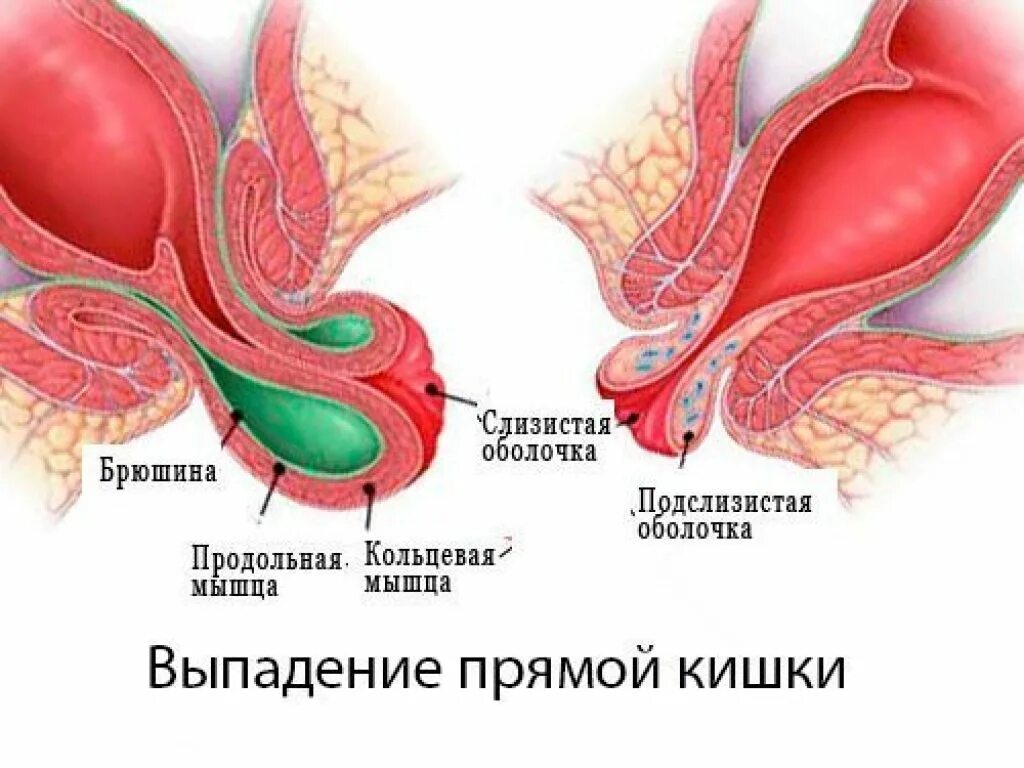 Опущение кишечника симптомы