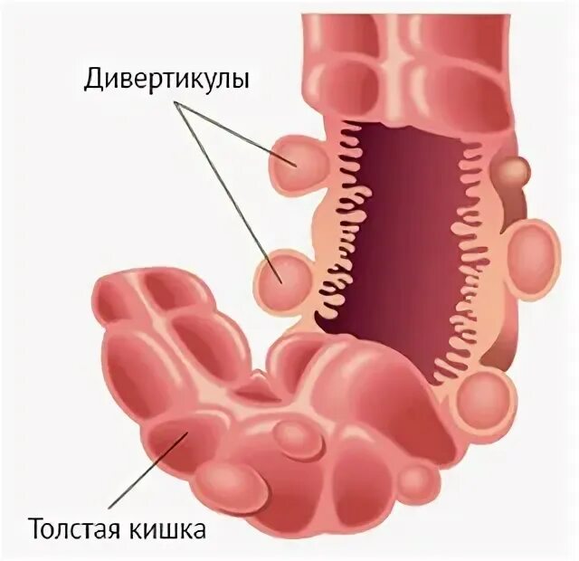 Дивертикулез кишечника. Дивертикулез кишечника клиника. Дивертикулёз кишечника симптомы. Юкстапапиллярный дивертикул.