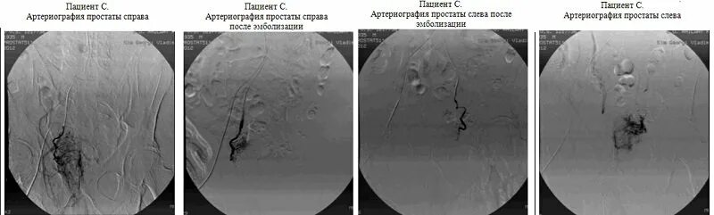 Артерии простаты. Эмболизация предстательной железы. Эмболизация артерий предстательной железы. Эмболизация аденомы простаты. Эндоваскулярная эмболизация артерий простаты..