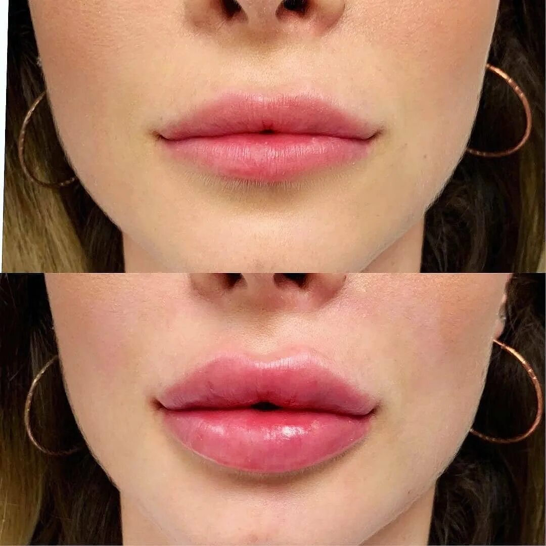 Аугментация губ гиалуроновой кислотой. Губы моны Лизы гиалуроновой кислотой. Увеличенные губы красивые.