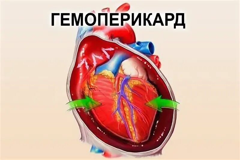 Скопление воздуха и крови в перикарде. Кровотечение в полость перикарда. Гемоперикард с тампонадой сердца. Причины гемоперикардита.