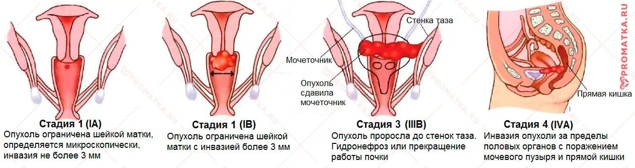 Рак 0 матки. РВК шейки матки стадии. Степени онкологии шейки матки.