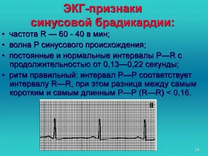 Экг диагноз синусовый ритм