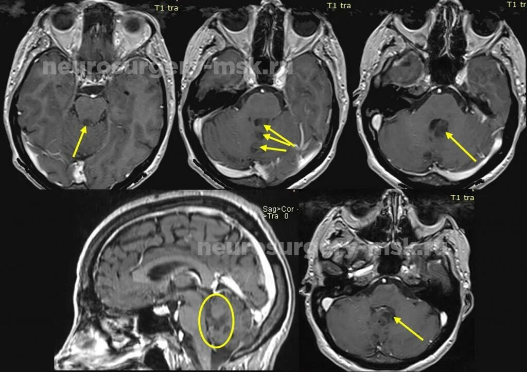 Опухоли желудочков. Опухоль червя мозжечка. Опухоль червя мозжечка мрт. Опухоль 4 желудочка головного мозга. Новообразование червя мозжечка мрт.