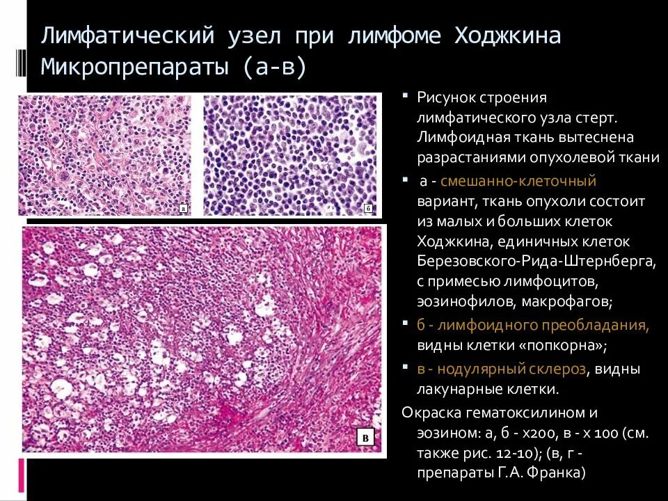 Лимфома Ходжкина патанатомия препарат. Лимфогранулематоз патанатомия. Лимфогранулематоз макропрепарат описание. Неходжкинская лимфома гистология. Реактивная гиперплазия лимфоузла