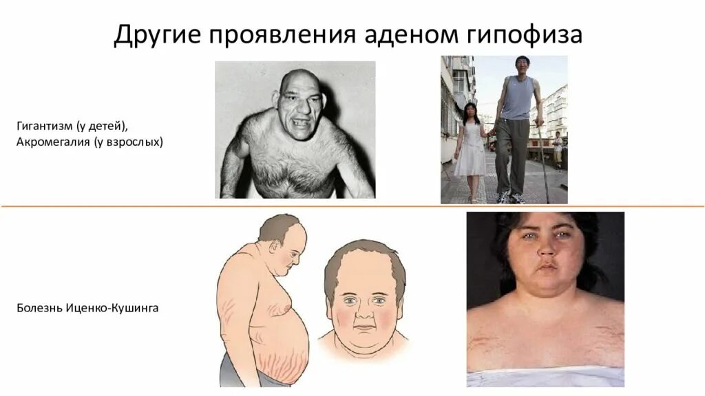 Гипофиза симптомы у женщин лечение прогноз. Синдром иценко кушинга опухоль гипофиза. аденома гипофиза иценко кушинга симптомы. • болезнь иценко-кушинга. микроаденома гипофиза. опухоль гипофиза болезнь иценко кушинга.