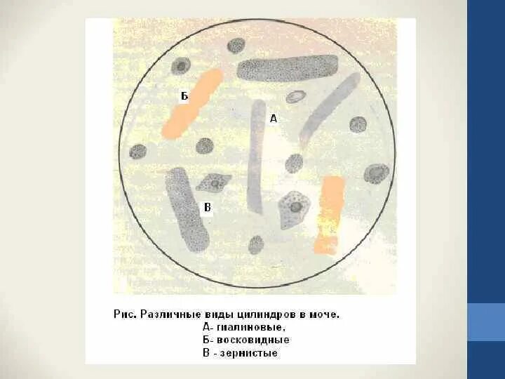 Повышены цилиндры в моче. Цилиндры гиалиновые зернистые восковидные. Гиалиновые зернистые и восковидные цилиндры в моче. Гиалиновые цилиндры в моче. Цилиндры гиалиновые 3.6.