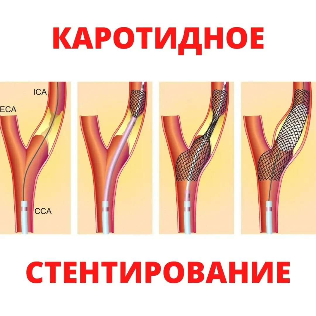 Эндартерэктомия это. Стентирование сонных артерий презентация. Операция атеросклероза сонной артерии. Стент графт для сонной артерии.