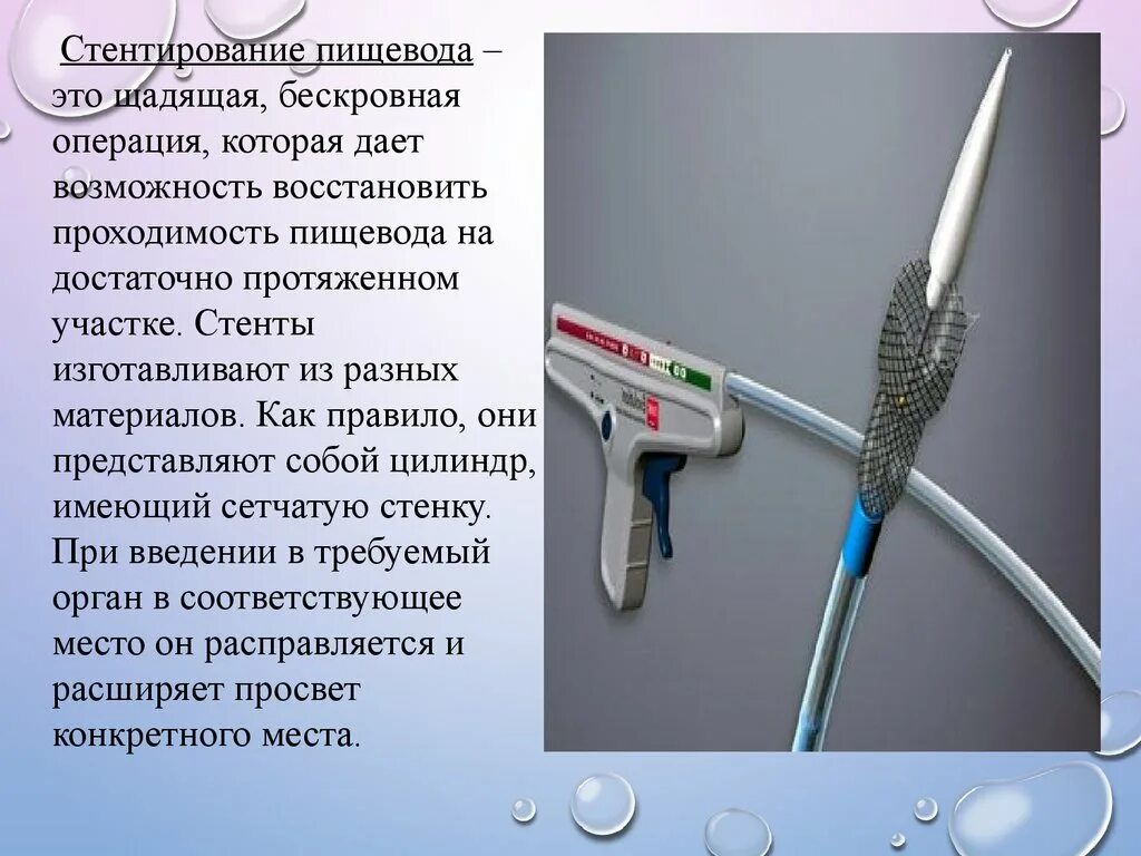 Срок стентирования. Стент для пищевода онкобольных. Стент пищеводный саморасширяющийся.