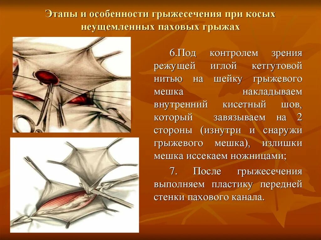 Этапы грыжесечения паховой грыжи. Этапы операции при грыжесечении. Грыжесечение при скользящих грыжах. Грыжесечение паховая этапы операции.