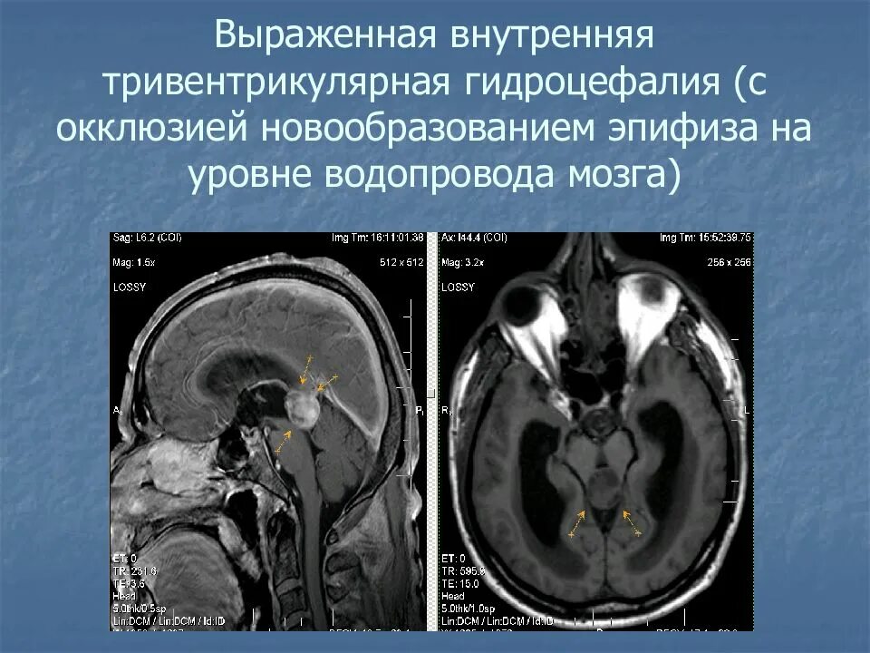 Выраженная заместительная гидроцефалия. Гидроцефалия головного мозга на кт. Окклюзионная гидроцефалия головного мозга кт. Наружная гидроцефалия головного мозга кт. Открытая гидроцефалия головного мозга кт.