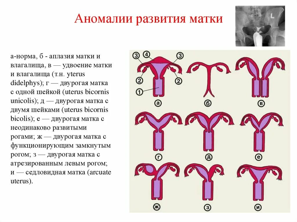 Недоразвитая матка у мужчин. Аномалии строения матки классификация. Врожденные аномалии развития матки. Удвоение матки классификация. Патологии развития матки.