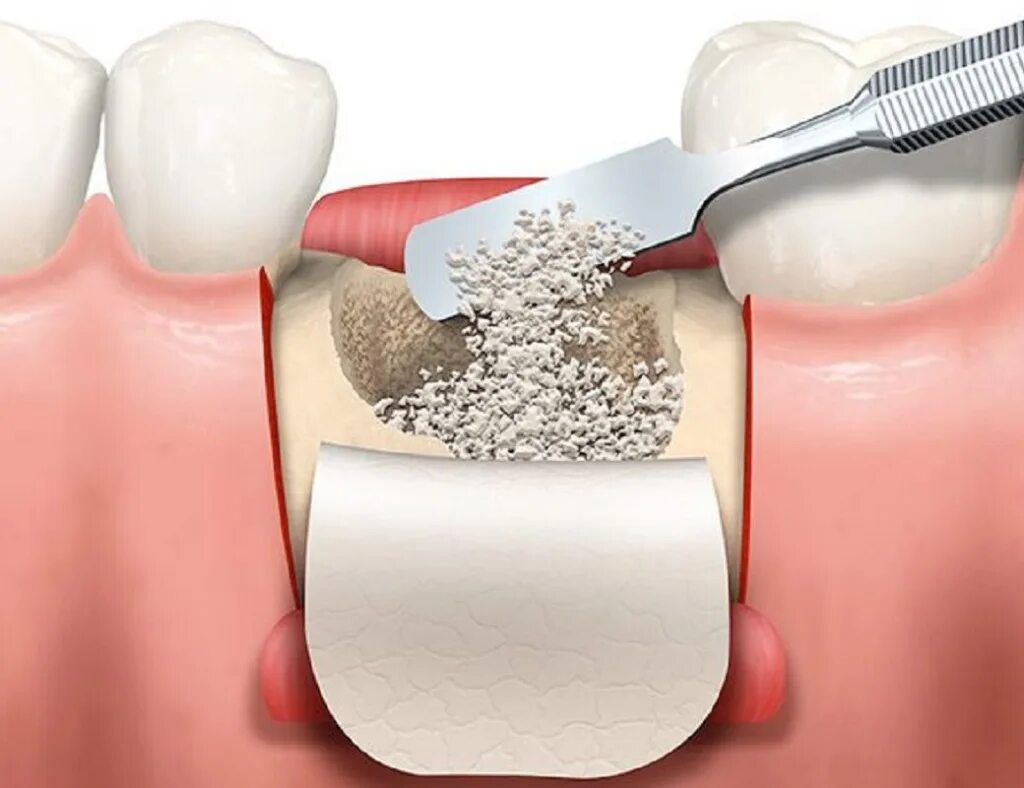 Temporomandibular joint reconstruction with alloplastic prosthesis: the outcomes