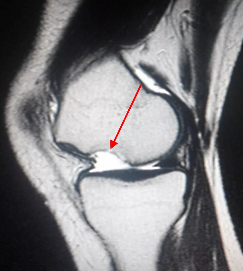 Хондромаляция медиальных мыщелков. Хондромаляция мыщелка мрт. Хондромаляция надколенника мрт. Рассекающий остеохондрит рентген. Синовит коленного сустава на кт.