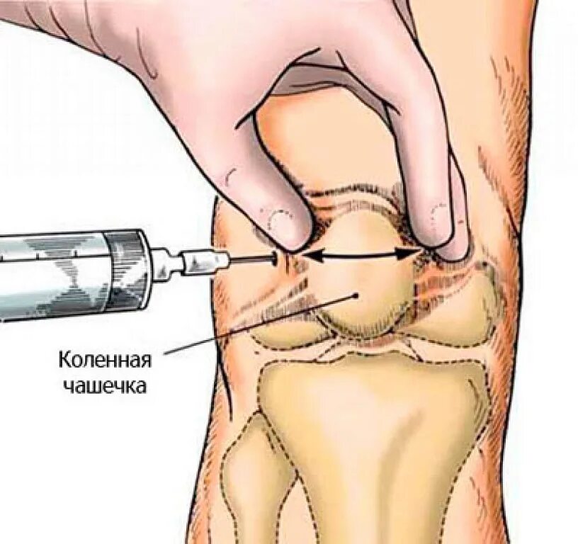 Точки пункции коленного сустава. Укол блокада Дипроспан. Техника пункции коленного сустава топографическая анатомия. Пункция коленного сустава топографическая анатомия.