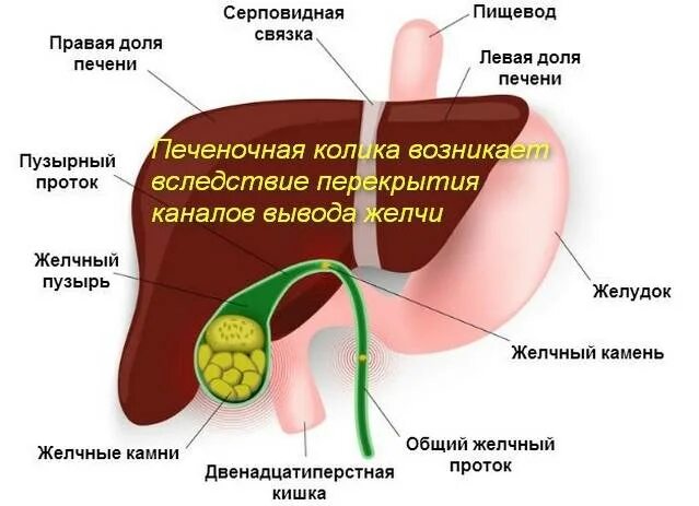 Желчная и печеночная колика. Желчная (билиарная, печеночная) колика. Печёночная колика симптомы. Печеночная колика патогенез.