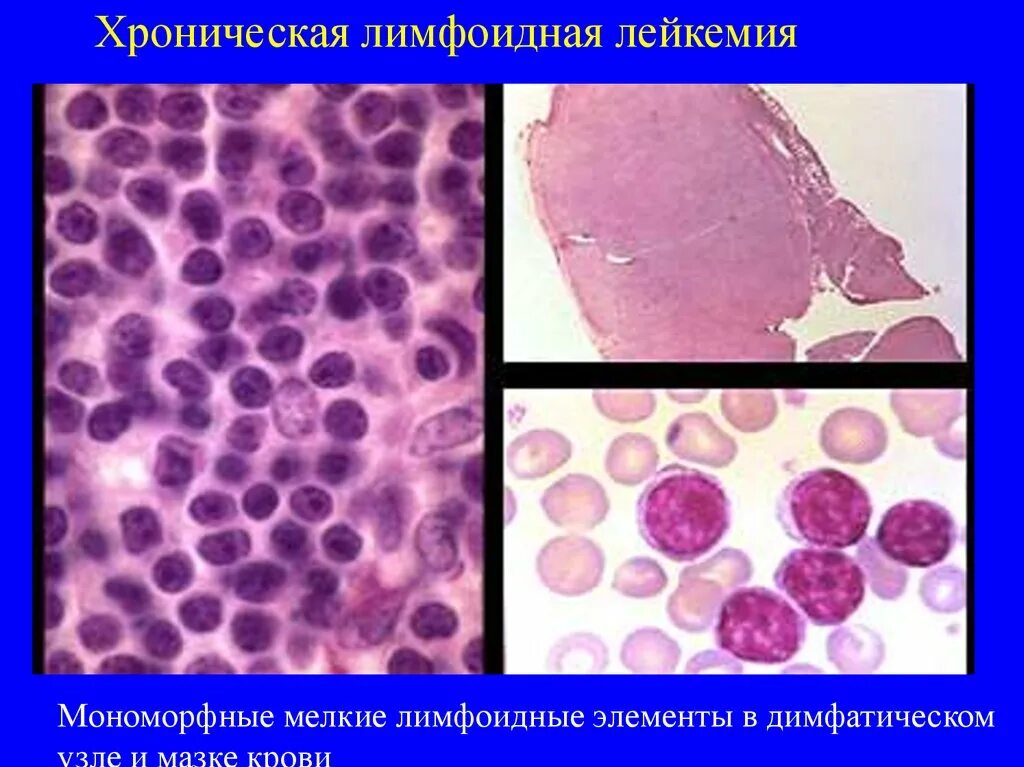 Принципы классификации опухолей кроветворной ткани. Опухолевое заболевание кроветворной и лимфатической ткани. Опухоли лимфоидной ткани. Лимфоидной кроветворной и родственных им тканей. Лимфоидной кроветворной и родственных им тканей.