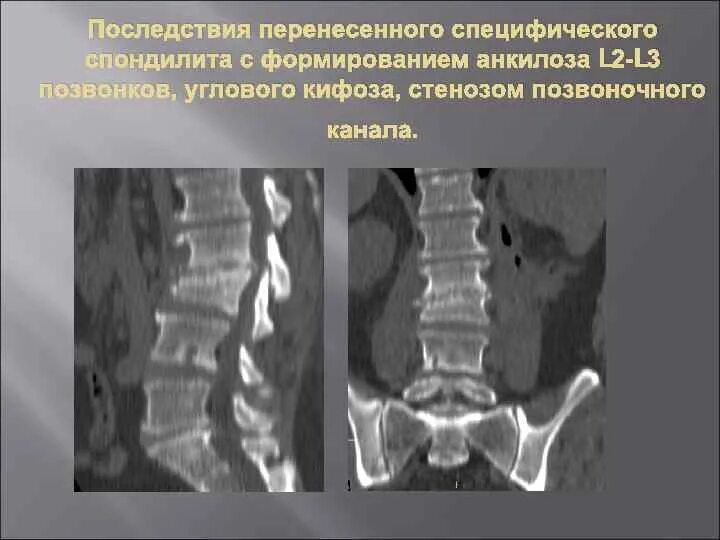 После операции на позвоночнике дают инвалидность. Болезнь Бехтерева шейного отдела кт. Болезнь Бехтерева рентгенография позвоночника. Анкилозирующий спондилит кт. Анкилоз позвонков рентген.